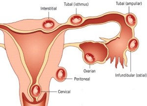 Ectopic pregnancy types 