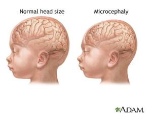 Microcephaly